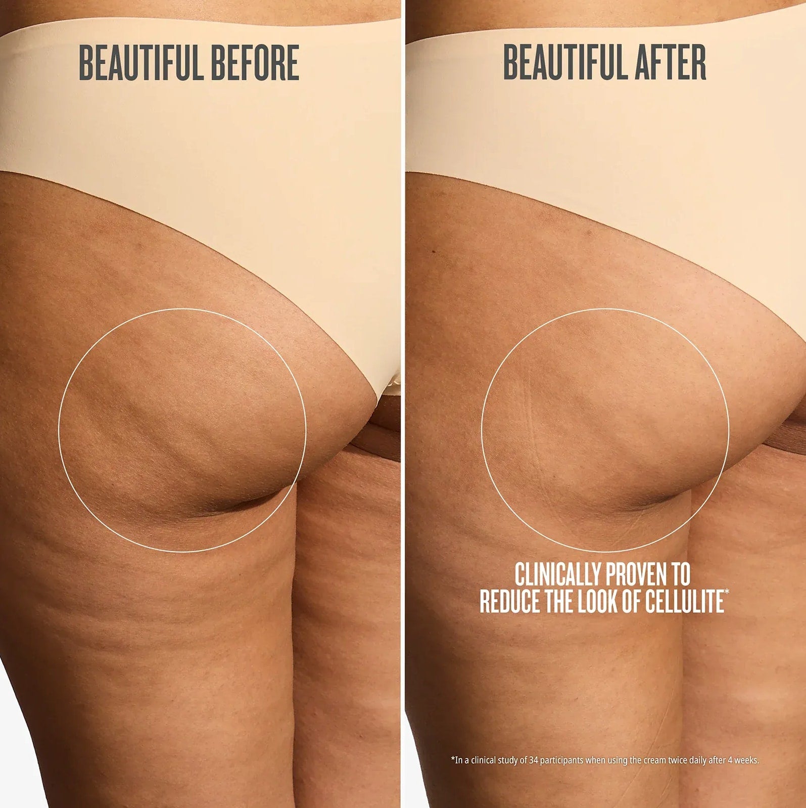 Before-and-after-comparison-of-cellulite